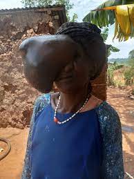 Beatrice Makokha’s 3kg growth removed  after 21 years.
